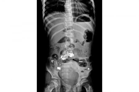 Қыз баланың асқазанынан скотч, қалам мен темір алынды