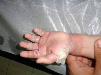 Қармақшыда екі сәби ыстық сорпаға күйіп қалды